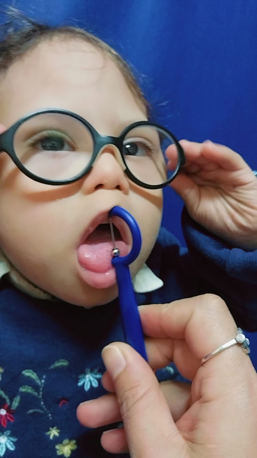 علاج فموي حركي